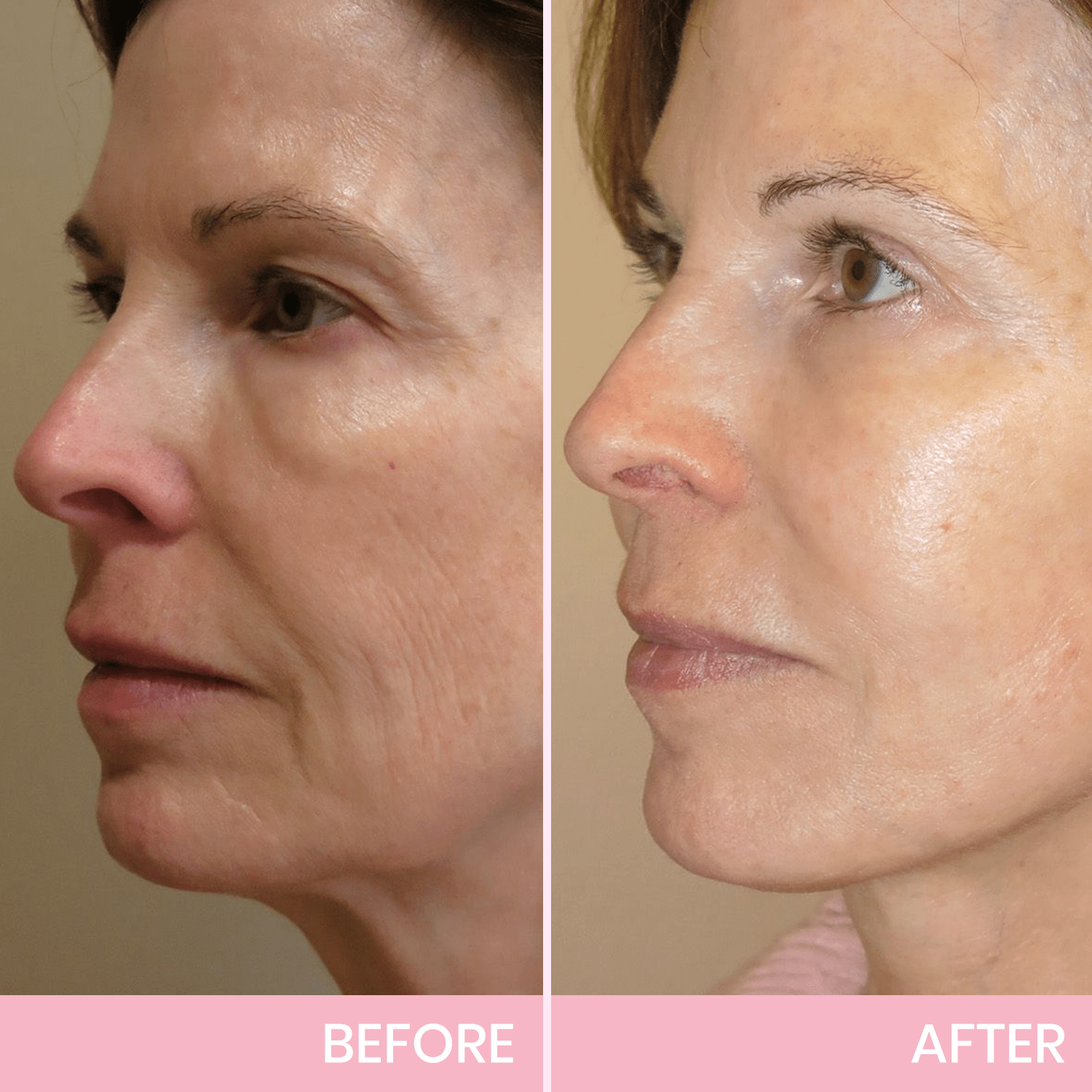 1+1 GRATIS! V-Face Lifting Tape | Jugendliche Ausstrahlung mit dem V-Face