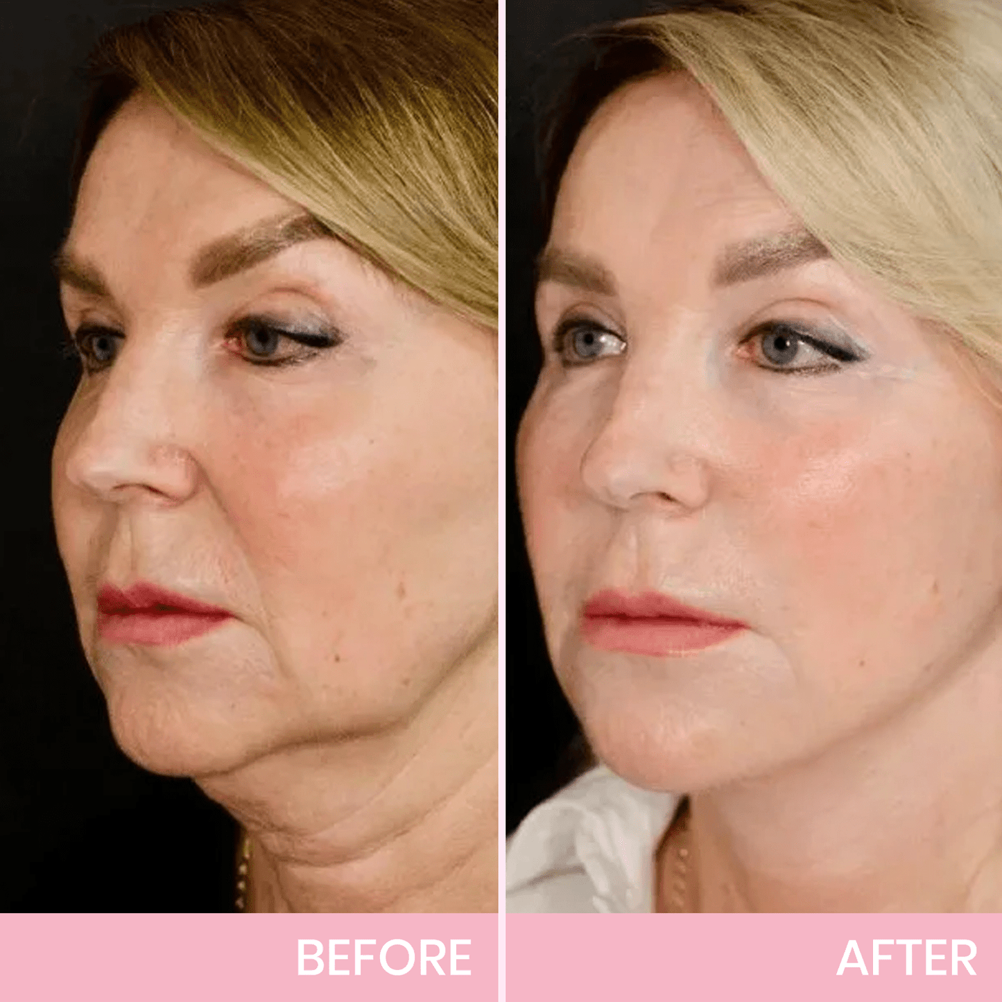 1+1 GRATIS! V-Face Lifting Tape | Jugendliche Ausstrahlung mit dem V-Face