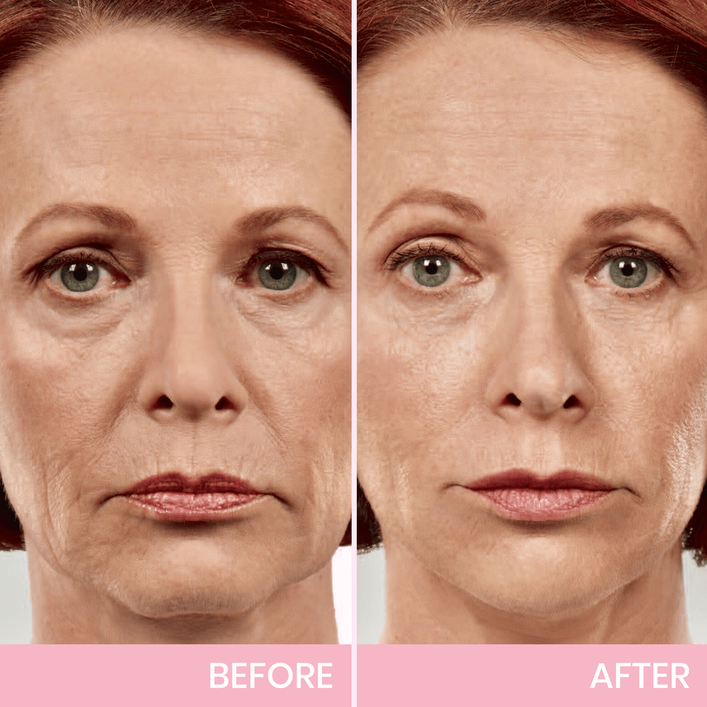 1+1 GRATIS! V-Face Lifting Tape | Jugendliche Ausstrahlung mit dem V-Face