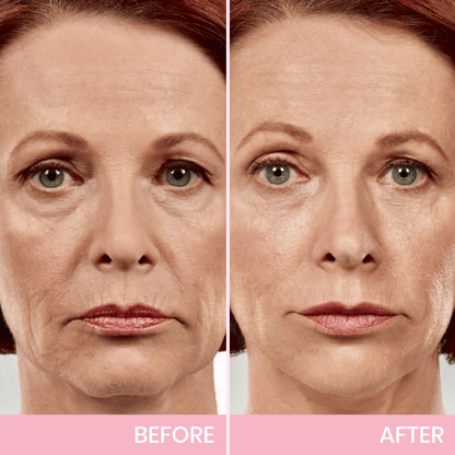 1+1 GRATIS! V-Face Lifting Tape | Jugendliche Ausstrahlung mit dem V-Face
