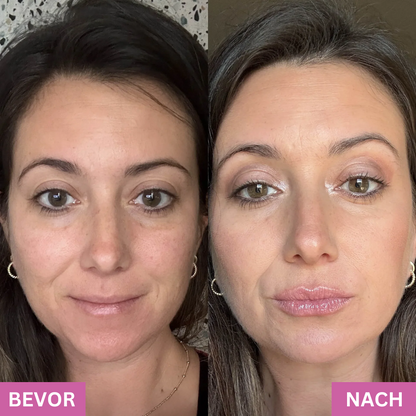 LipBoost™ | Lippen-Roller