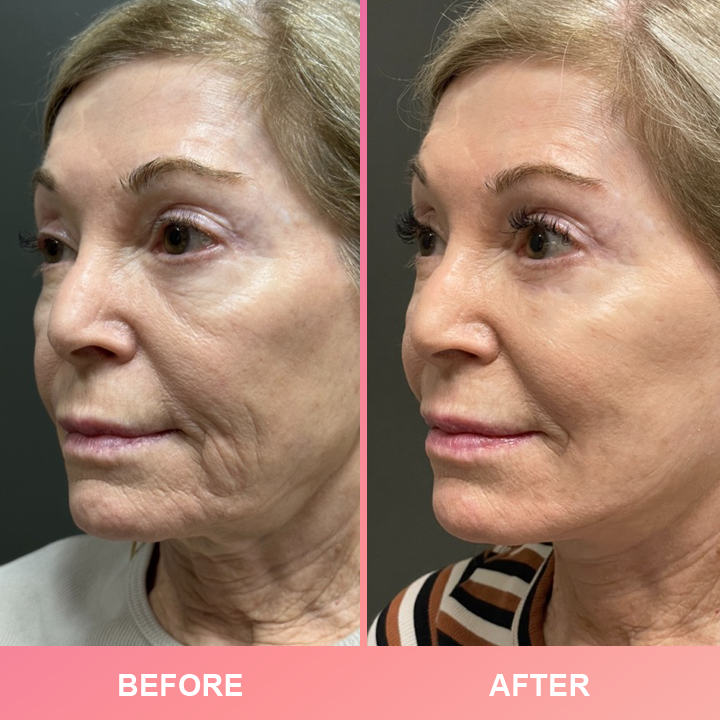 1+1 GRATIS! Anti-Wrinkle Bar| vollere, festere und jugendlichere haut