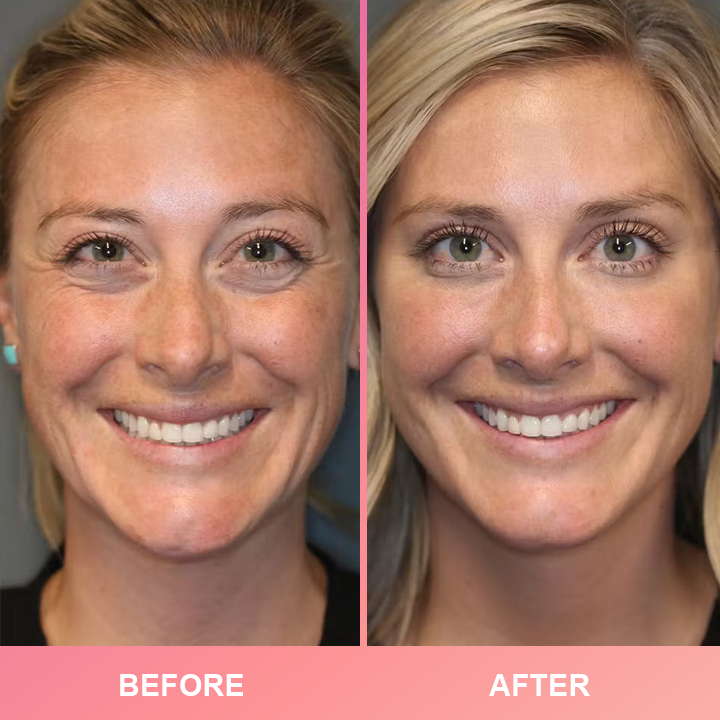 1+1 GRATIS! Anti-Wrinkle Bar| vollere, festere und jugendlichere haut