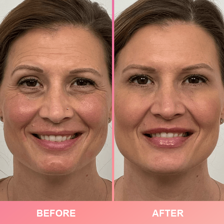 1+1 GRATIS! Anti-Wrinkle Bar| vollere, festere und jugendlichere haut