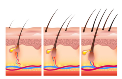 1+1 GRATIS! Rosmarinöl™ | Haarwachstum