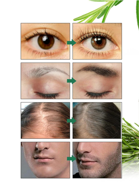 1+1 GRATIS! Rosmarinöl™ | Haarwachstum