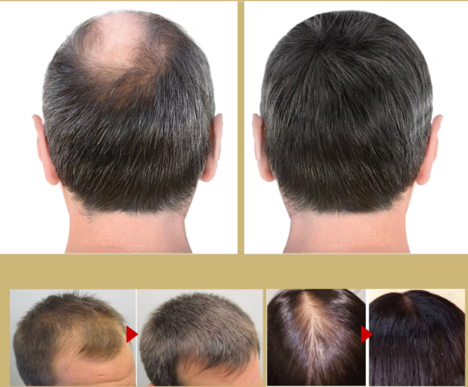 Wärmehaar™ | Infrarot-Haartherapiehaube