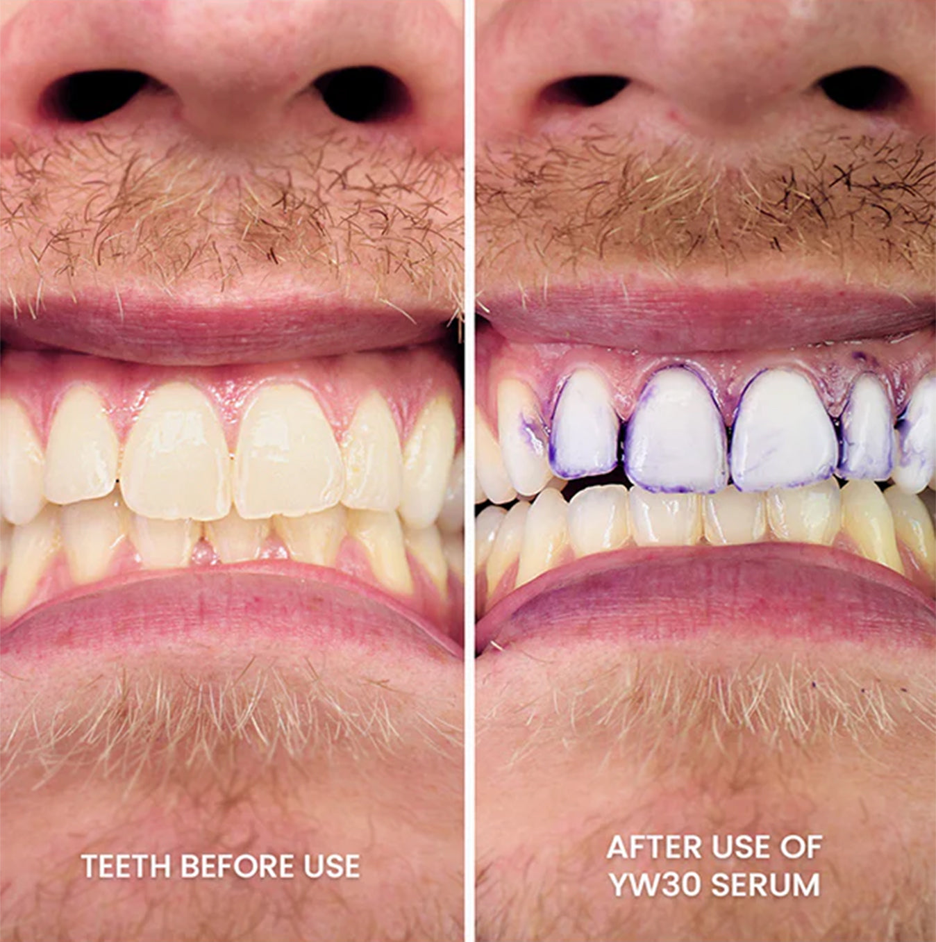 1+1 GRATIS! V34 WhiteGlow™ | Farbkorrektur Zahnpasta