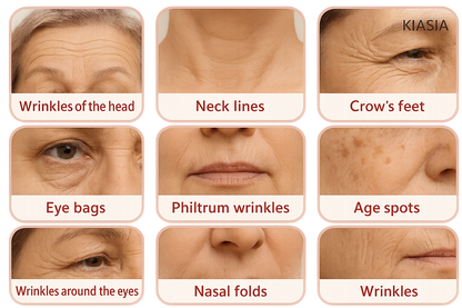 KIASIA huidproblemen overzicht met verschillende soorten rimpels en huidcondities